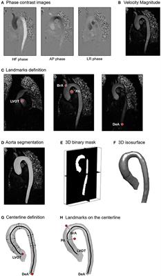 4D Flow Analysis of BAV-Related Fluid-Dynamic Alterations: Evidences of Wall Shear Stress Alterations in Absence of Clinically-Relevant Aortic Anatomical Remodeling